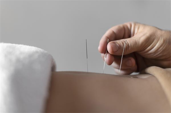 Dry Needling