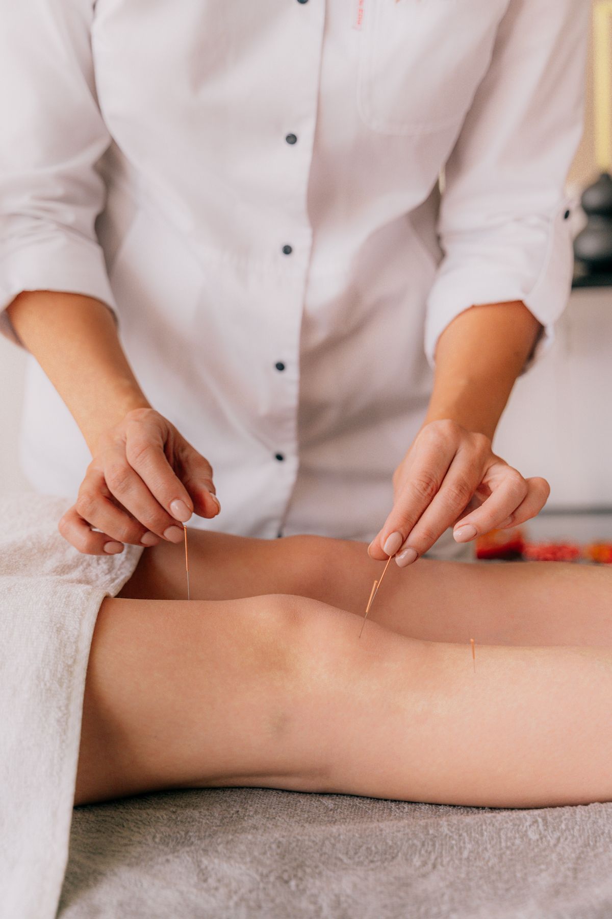 Dry needling treatment around the knee during a physical therapy session