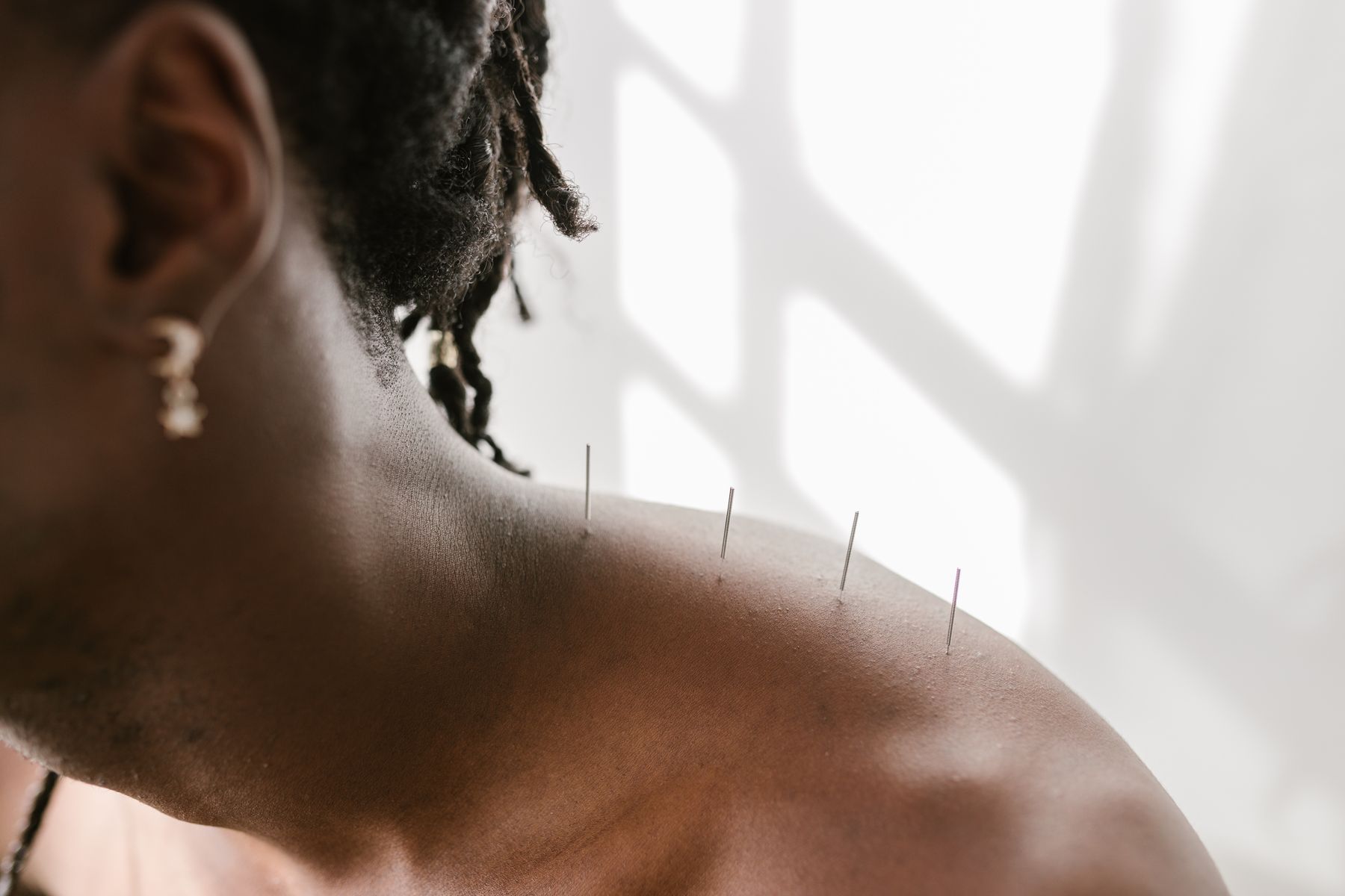 Dry needling
