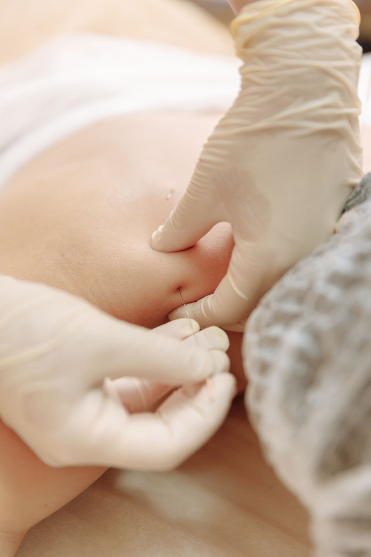 Physical therapist performing dry needling on a patient's low back
